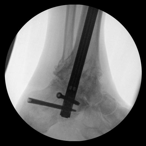fusion underwent a subtalar arthrodesis with two headless compression screws. One year after the procedure, he still had pain in the lateral hindfoot.