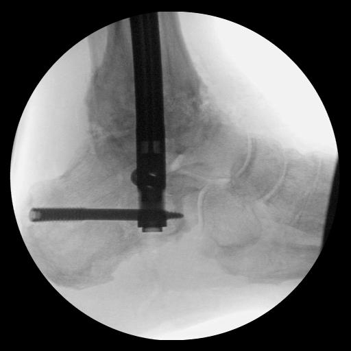 Successful fusion was achieved across the subtalar joint, but non-union of the ankle joint resulted in hardware failure.