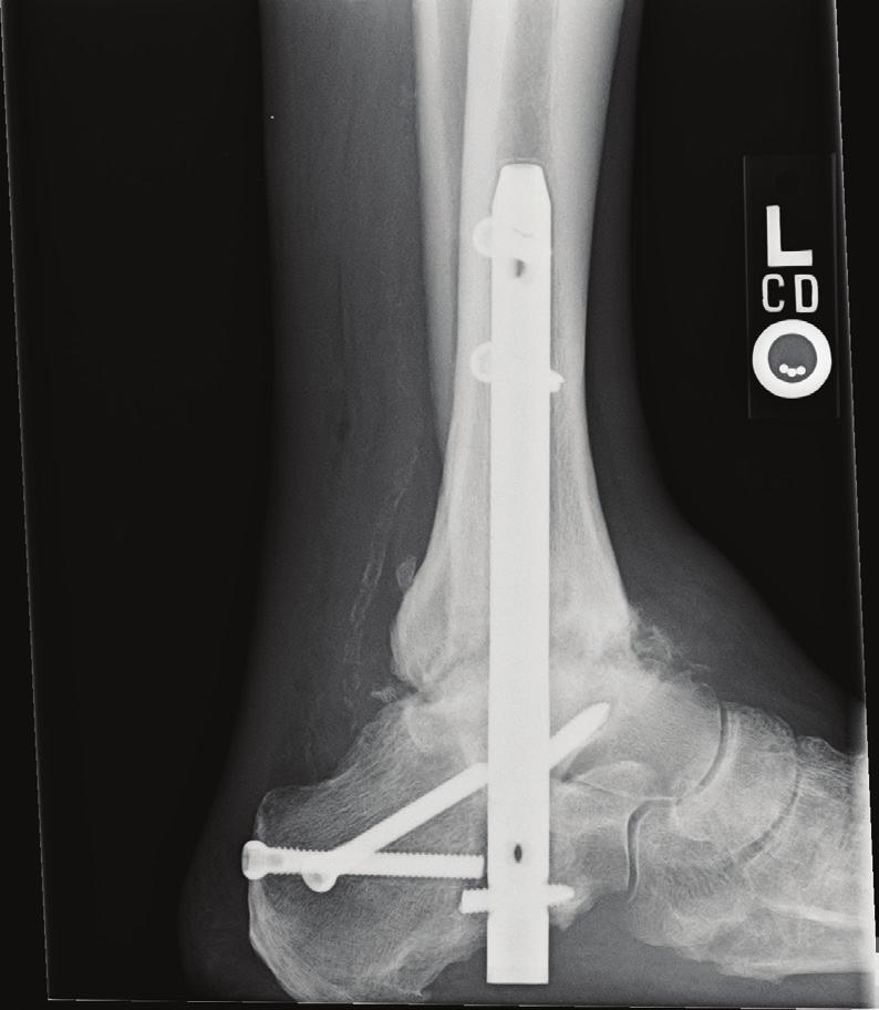 After one year, there was no visible bony union of the ankle joint and a revision TTC fusion was scheduled. Procedure The nail and broken screws were removed.