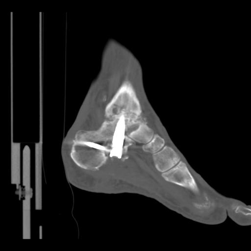 The radiograph revealed that the Compressive Element had unloaded 5 mm in response