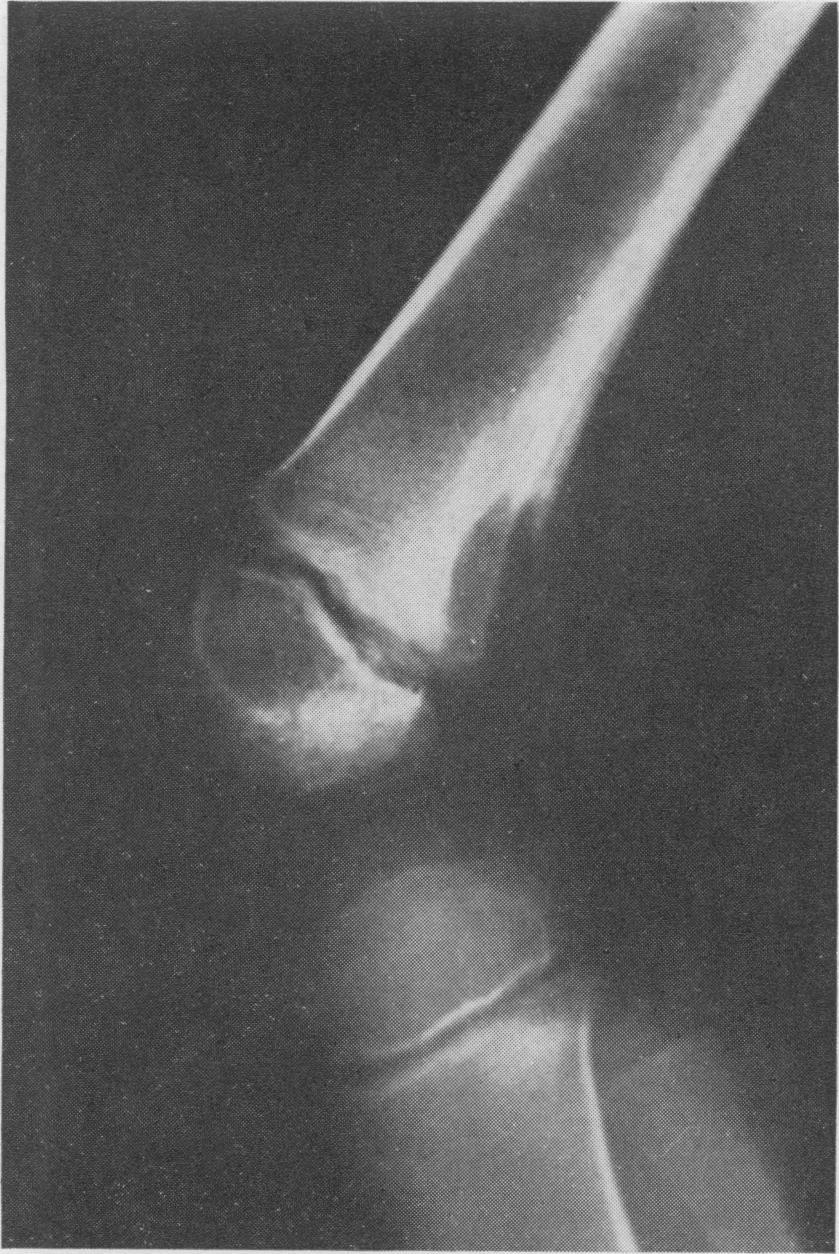 POSTGRAD. MED. J. (1965), 41, 672. FIBROUS CORTICAL DEFECT AND NON-OSSIFYING FIBROMA PETER G. BULLOUGH, M.B., Ch.B. JON WALIFY, F.R.C.S. Nuffield Department of Orthopaedic University of Oxford, Surgery, and Department of Orthopaedics, War Memorial Hospital, High Wycombe.