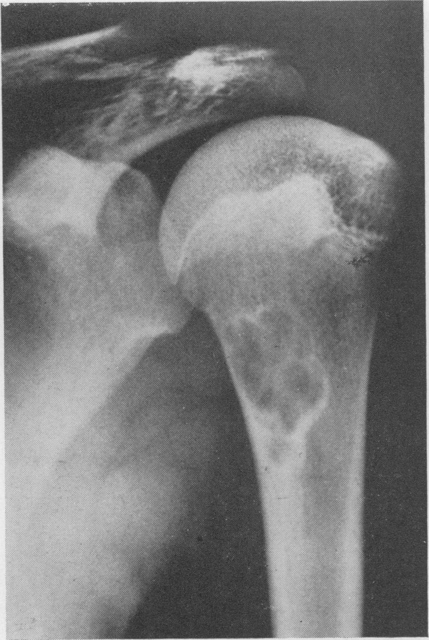 November, 1965 BULLOUGH and WALLEY: Fibrous Cortical Defect 673 I FIG. 2.-A non-ossifying fibroma of the humerus in a 12-year-old girl (Case 3). Case No. 5.
