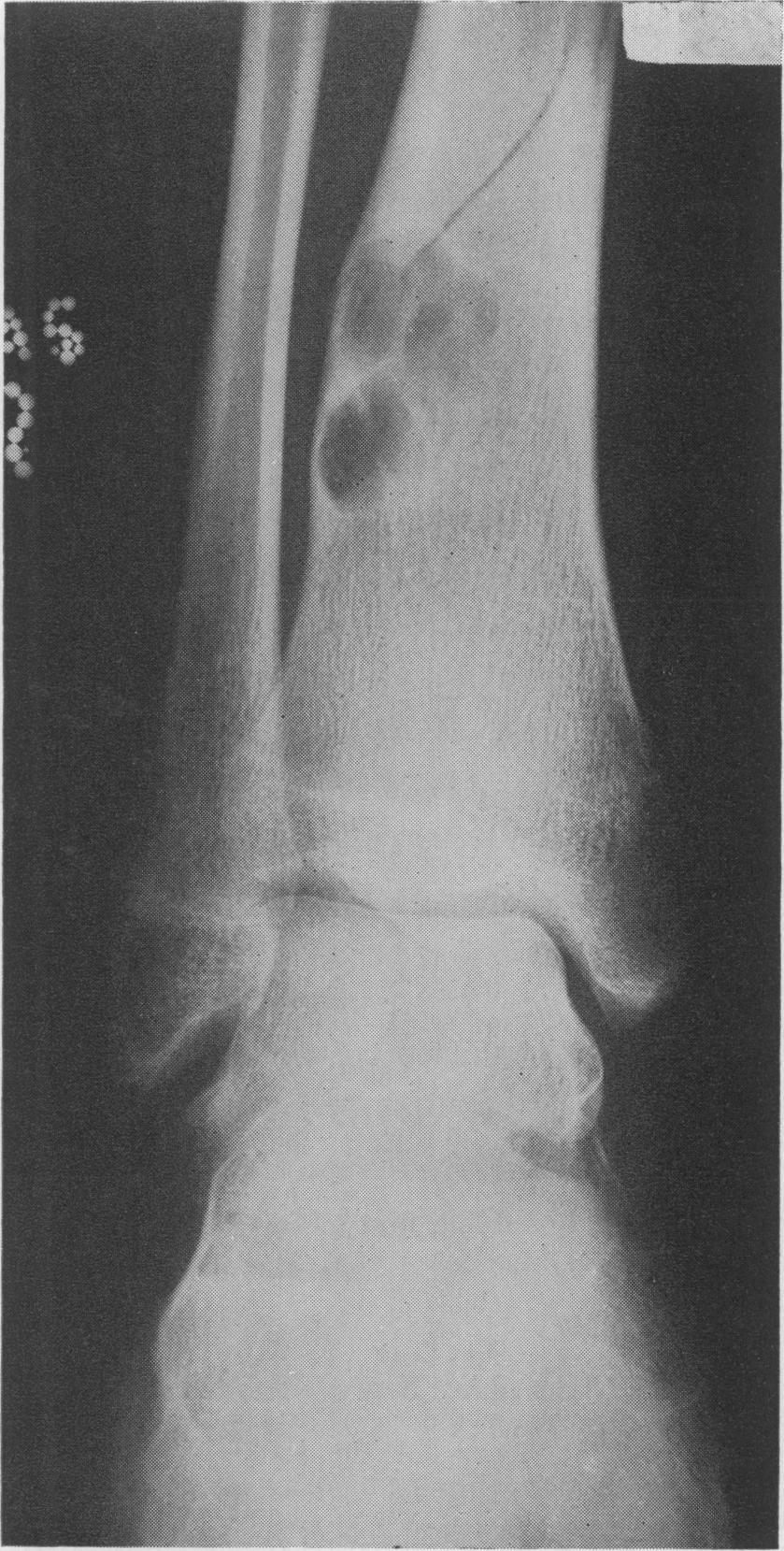 In keeping with cases reported here most of the tumours occur in the ends of the long bones of the lower limb.