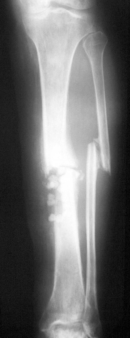 AW Infected nonunion tibia with loose nail