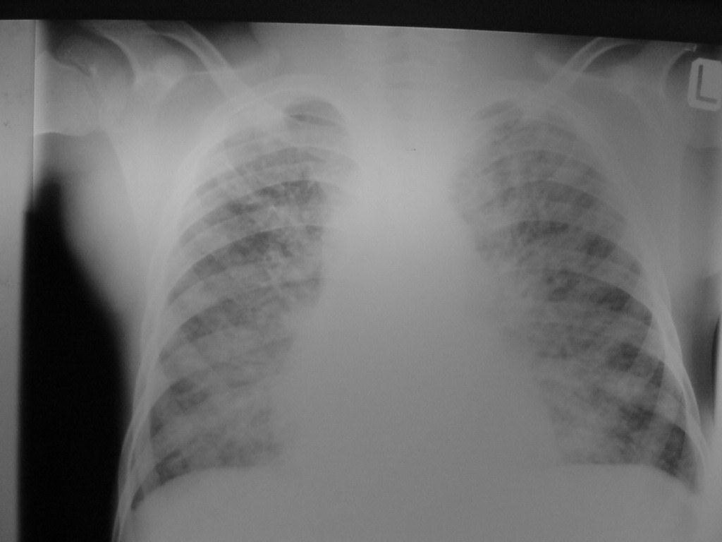 Miliary TB can be difficult to differentiate in