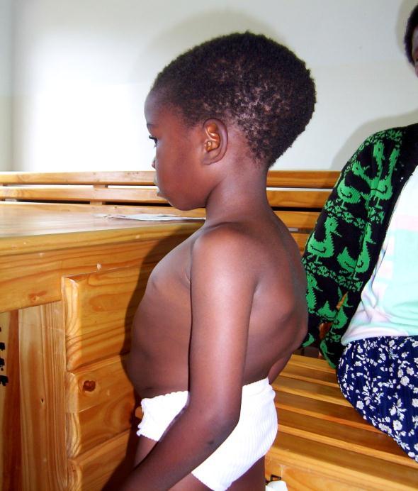 Osteoarticular TB is not uncommon in children, again