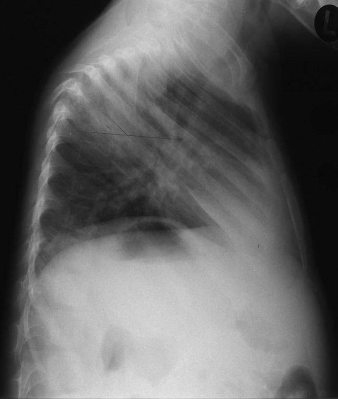 Spinal TB causes destruction of vertebral bodies
