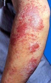 湿疹 pic 1