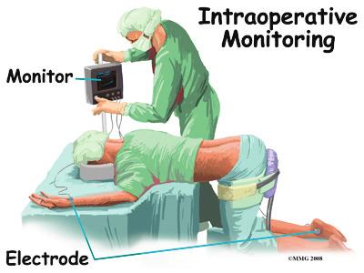 When is intraoperative monitoring used for spinal surgery? Some spine surgeons may prefer to use intraoperative monitoring during most (if not all) of their surgeries.