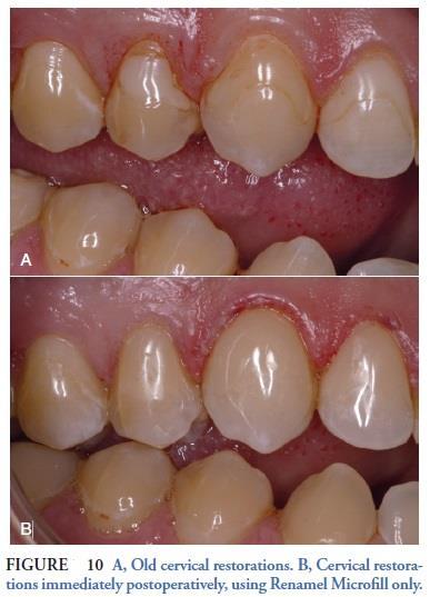 anterior bridges, and porcelain repairs (Figure 13) which can all be constructed with direct composite resin.
