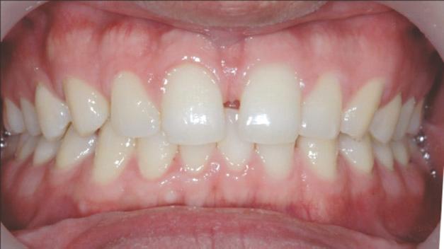 A clinical examination revealed 2 mm space between maxillary central incisors, with favorable gingival hygiene (Figure 1). The patient didn t want orthodontic or prosthodontic considerations.