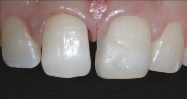 The analysis of the length and the width of the upper central incisors demonstrated an unfavorable proportion after the closure with composite resin (Figure 3).