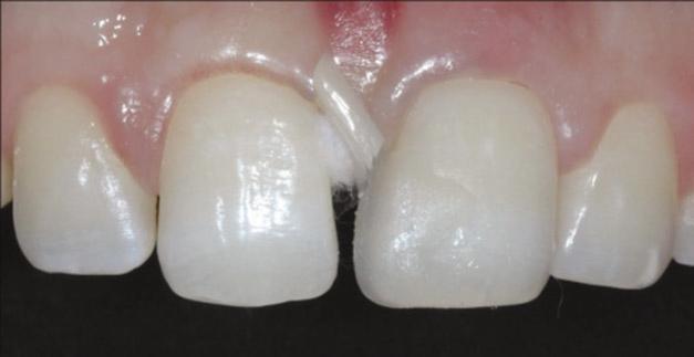 In this case, because of the large space and thick gingival biotype, the increase of emergence profile was difficult.