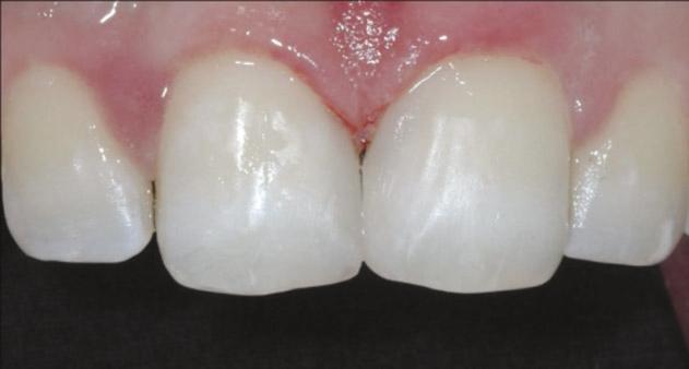 Diastema closure in central incisors can be successfully accomplished using direct adhesive