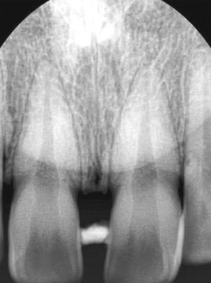 After 3 months later, interdental space was filled with interdental papilla (Figure 6c).