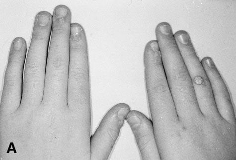 556 British Journal of Plastic Surgery Figure 2 (A) A 14-year-old boy with multiple simple warts on his hands