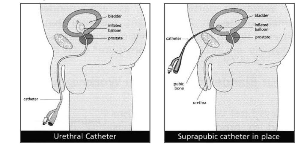 Managing your bladder with a Supra-pubic catheter at home The purpose of a catheter is to drain urine from the bladder What is a Supra-pubic catheter?