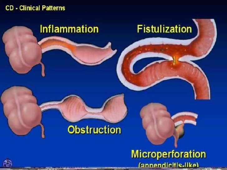 Inflammation -> Fistula,