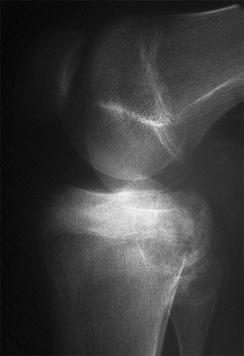 shoulder after trivial injuries before lesions in the proximal humerus were discovered. The most common symptom was pain around a joint accompanied by loss of function.