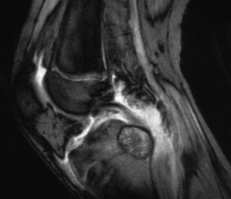 The mean time to recurrence was ten months (4 to 17) (Fig. 2). In patients with recurrent lesions none had an associated aneurymsal bone cyst on histopathological examination.
