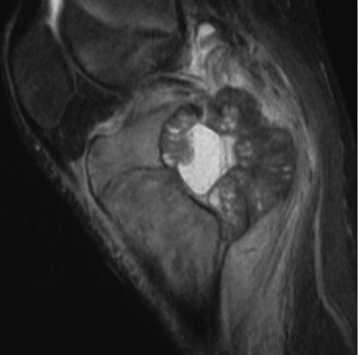 Local recurrence was diagnosed on the basis of three features: 1) the failure of symptoms to resolve or their return; 2) the radiological appearance when a previously curetted Fig. 3a Fig.