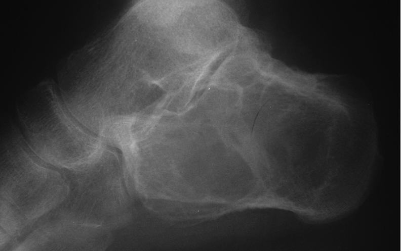 CHONDROBLASTOMA OF BONE 977 Figure 4a Radiograph of the calcaneum showing a cystic lesion with an intact but thinned cortex. Figure 4b CT showed numerous fluid levels typical of aneurysmal bone cyst.
