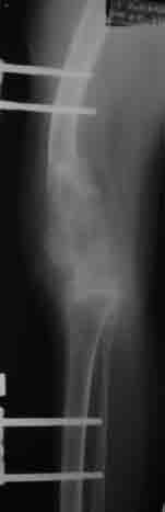 A sound arthrodesis and 13 cm of lengthening bone were simultaneously obtained. e-f: Clinical and radiographic controls taken 20 months after the initial procedure.