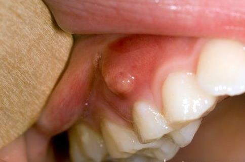 Infection/Abscess Palpate area If fluctuant and tender to touch it is an abscess Antibiotics of choice for dental