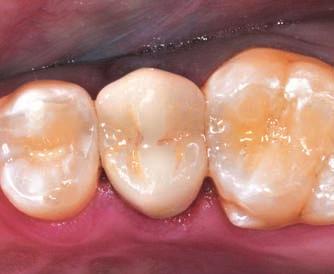 ceramic 5 Preoperative photo of tooth to be