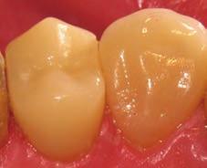 bonded when desired Resists chipping compared to a layered ceramic or PFM restoration