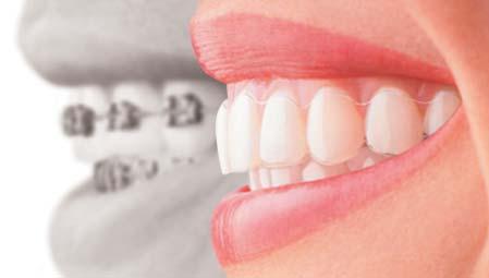 Almost anyone can utilize the latest technologies in dental care to improve their smiles without the look of traditional braces. Who wears INVISALIGN?