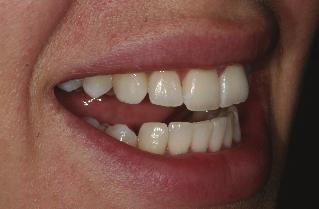treatment Figure 6: Front view after treatment A dentist had referred the patient to him to assess her for veneers.