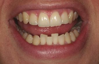 Space calculation again showed that this case was treatable with an Inman Aligner. The Aligner was constructed and fitted a week later.