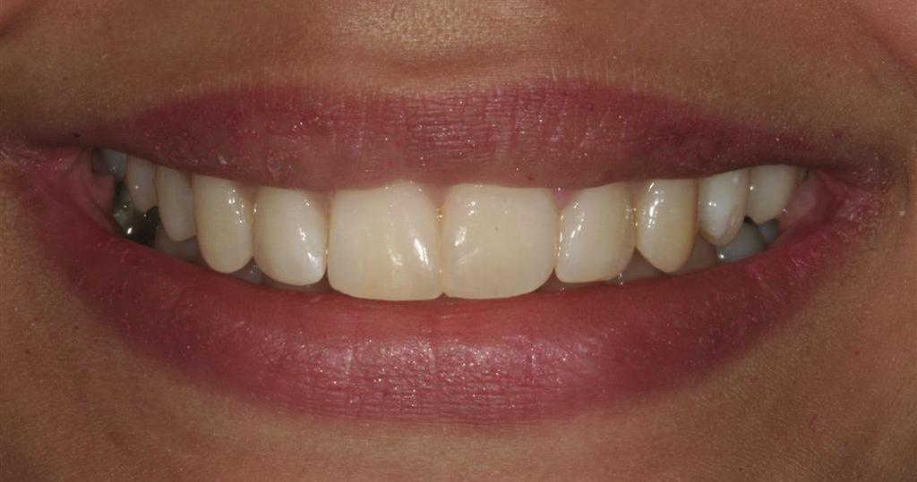 Often this may only take a few weeks, but I have not had an exposure or had a veneered tooth need