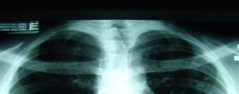 TB and AIDS TB reported in up to 10% of AIDS patients radiographic