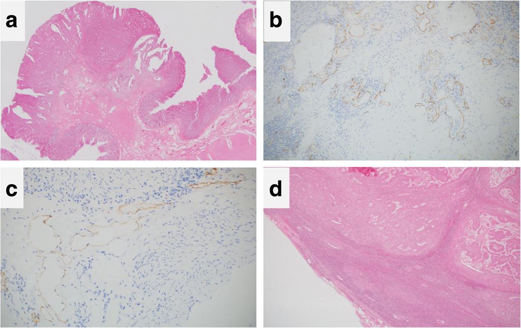 d The resected lateral lymph nodes confirmed a metastasis of moderately differentiated adenocarcinoma Fig.