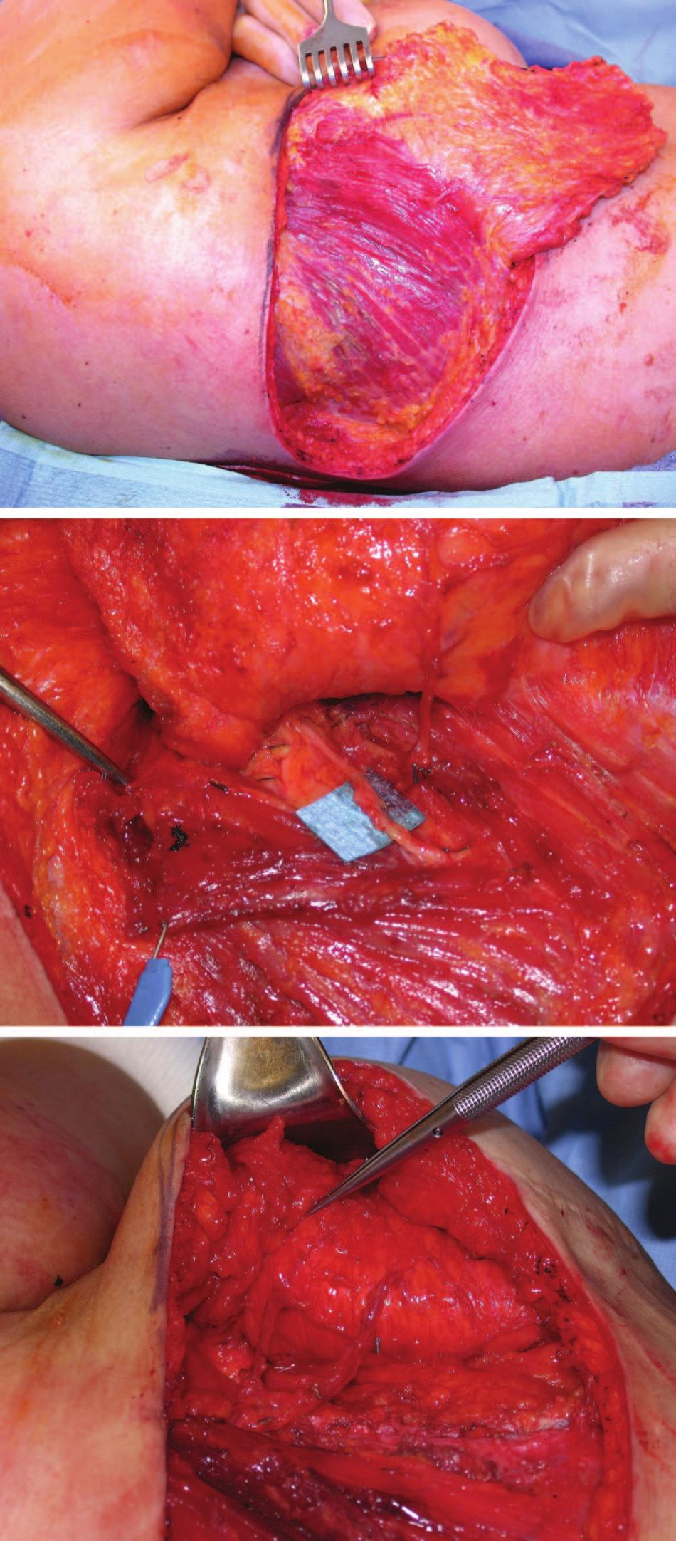 764 PLASTIC AND RECONSTRUCTIVE SURGERY, September 1, 2005 FIG. 3. The defect is closed primarily and the drain is placed.