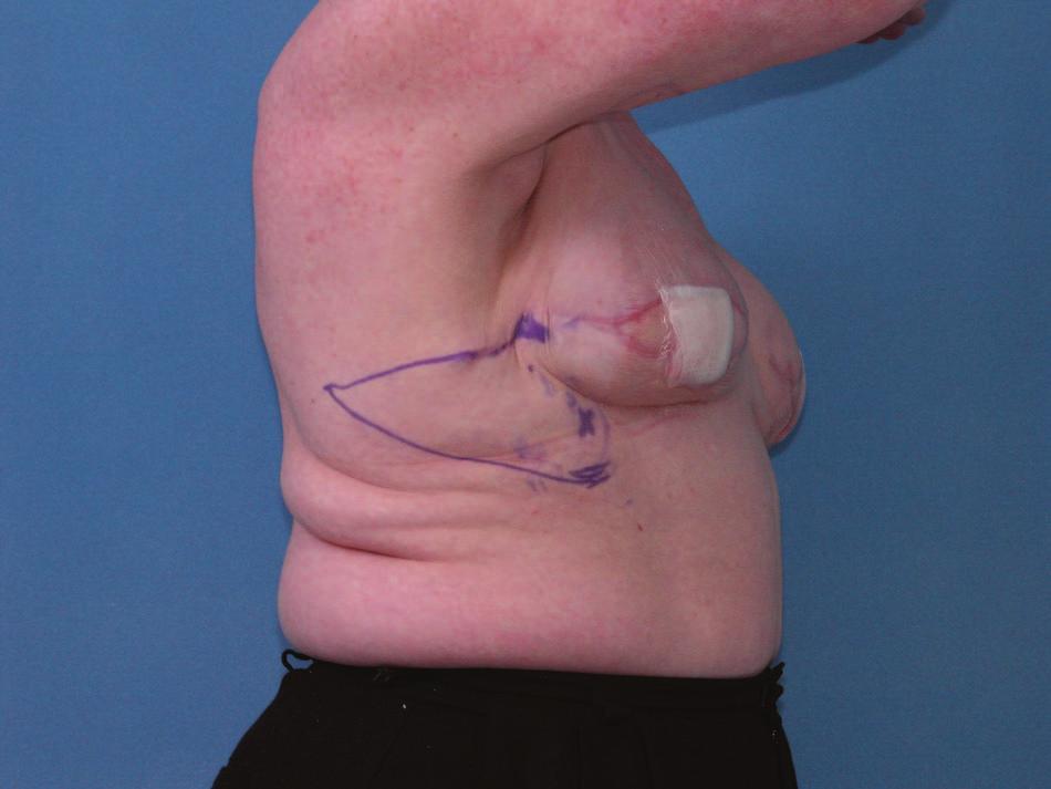 Postoperatively, the patient s right reconstructed breast was smaller than the left, and the patient requested better symmetry. The flap was designed similar to those in cases 1 and 2.