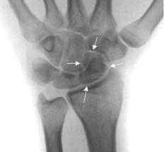 bone is also excessively bent in the coronal plane. In addition, when the distal fragment is flexed, it is forced into pronation by its articulation with the capitate.