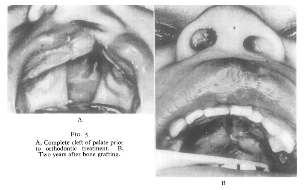 In unilateral cases the results have been impressive in that only three examples of alveolar collapse occurred in 21 cases.
