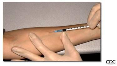 Tuberculin Skin Testing (Mantoux) Common proven method for identifying LTBI Mantoux test is preferred to other types PPD: purified protein derivative Must be read by trained