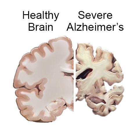 Understanding Alzheimer s Disease Alzheimer s disease is an irreversible, progressive brain disorder that slowly impacts memory, thinking, skills and, eventually, the ability to carry out the