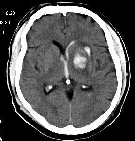Early Expansion of Intracerebral Hemorrhage Prospective study of 103