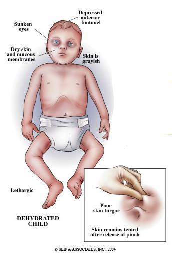Rotavirus Vaccines Examples of dehydration caused by Rotavirus Protect against