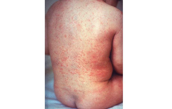 Photos: CDC Measles, Mumps, & Rubella Vaccine