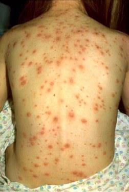 Varicella Vaccine Protects against varicella (chickenpox) Video: http://www.