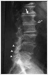 Lumbosacral spondylosis Osteoarthritis of the lumbosacral spine may cause
