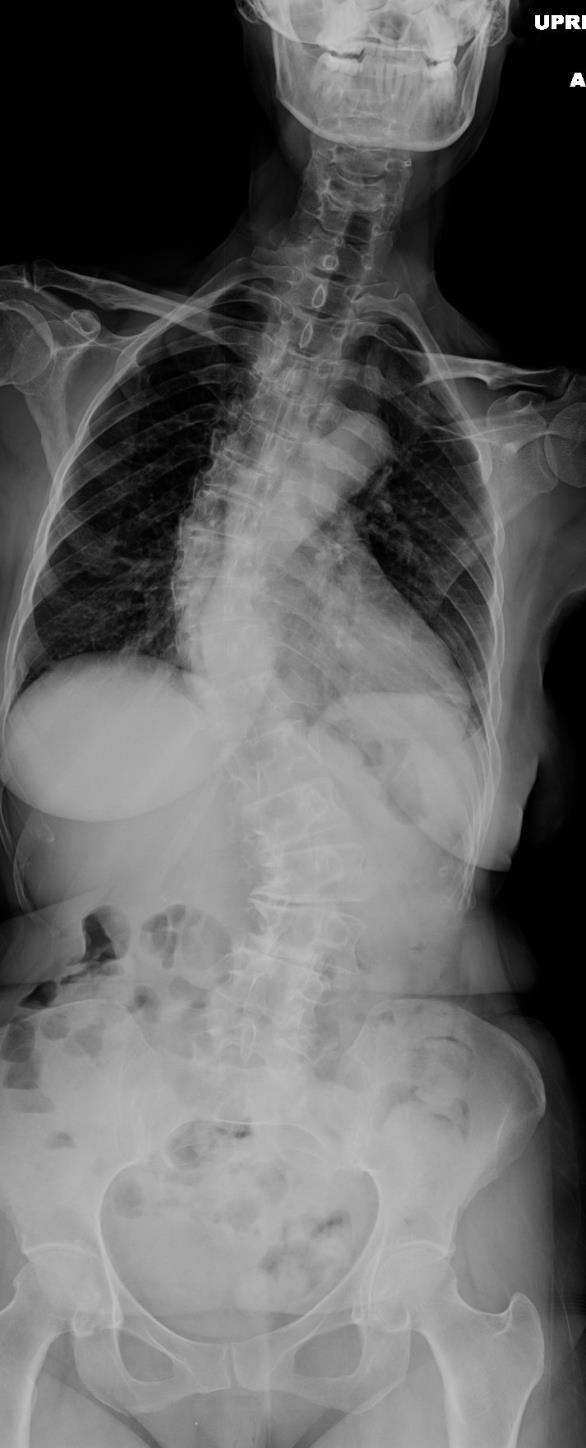 Scoliosis / Spinal Deformity Scoliosis is common in the eldery Leaning forward