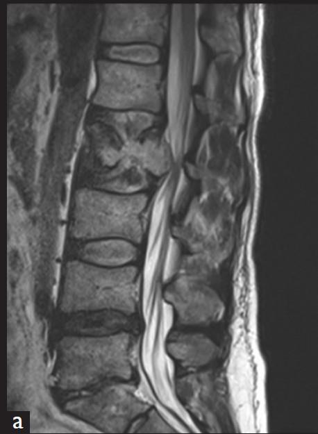 Spinal Disorders: A Primer Mechanical (Degenerative/Traumatic)* Rheumatologic