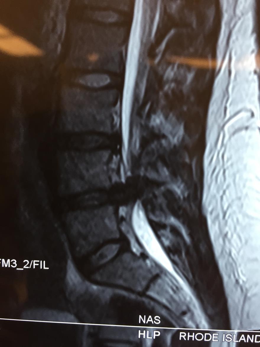 Lumbar disc herniation The nucleus acts as a shock absorber Nuclear material is